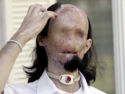 Dallas Wiens Third Man To Get Full Face Transplant in America