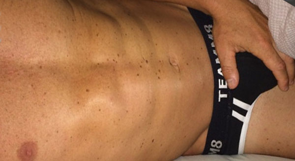 Doctores Son Exitosos En Primer Trasplante De Pene