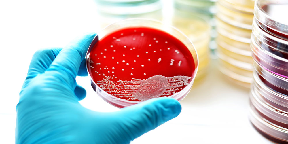 Infections sexuellement transmissibles: Faut-il avoir peur de la gonorrhée intraitable?