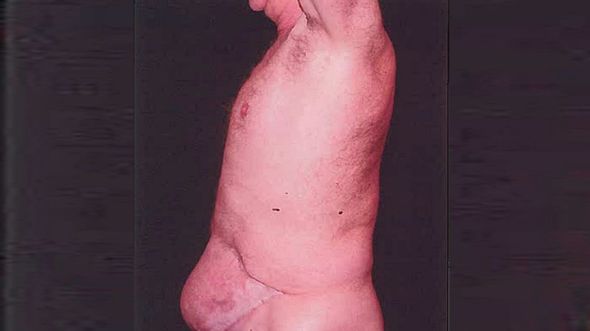 penis settlement nine months pregnant ข้อยุติเกี่ยวกับอวัยวะเพศ