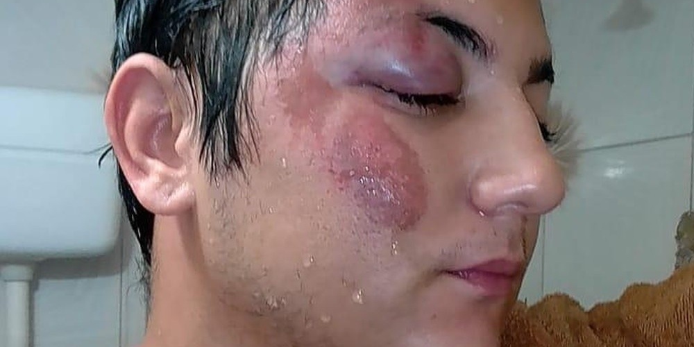 Vítima de homofobia é espancado por 4 homens em lanchonete no Ceará